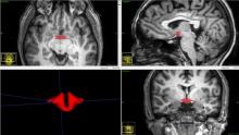 Magnetic resonance images show a reduced hypothalmus volume in women on OCs.